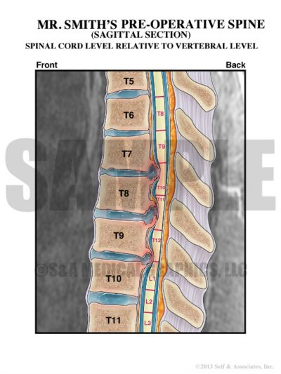 Thoracic Spine Fusion Case Study - S&A Medical Graphics