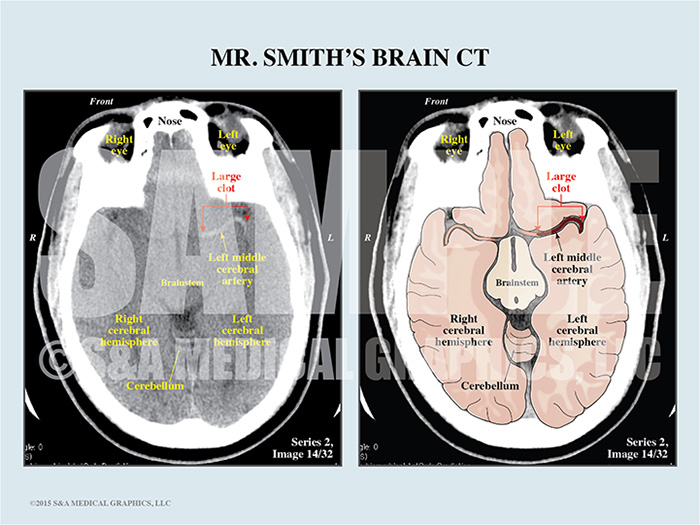 Brain CT Stroke Interpretation