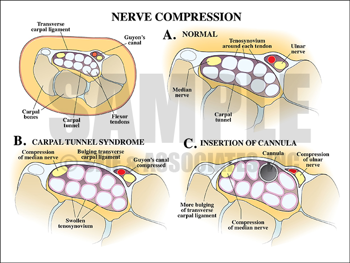 Nerve Compression Carpal Tunnel Medical Illustration
