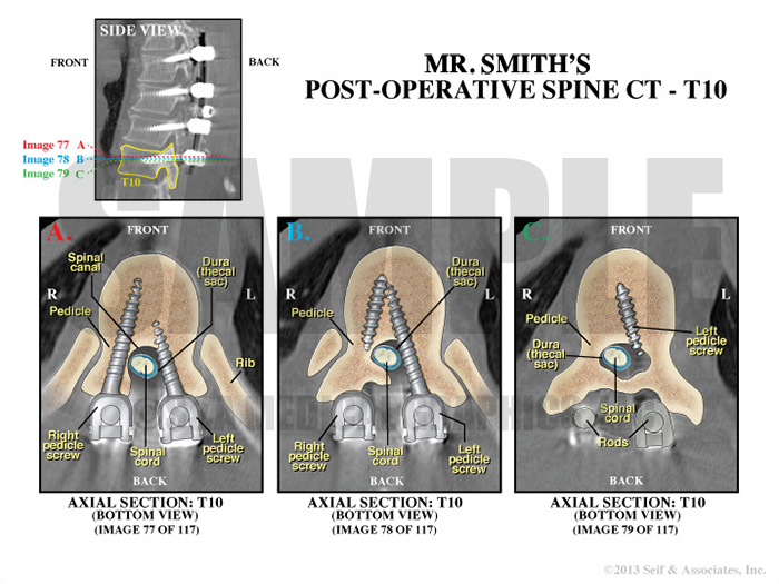 Postoperative spine ct medical illustration