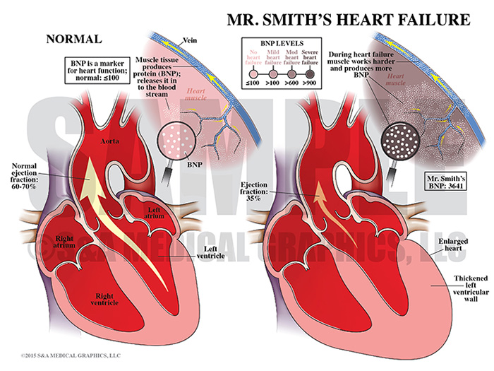 Heart Failure Medical Illustration
