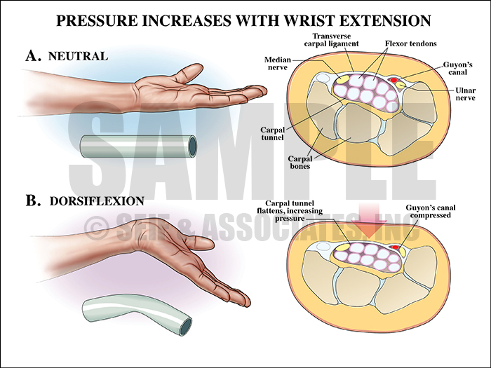 Pressure Increase Carpal Tunnel Medical Illustration