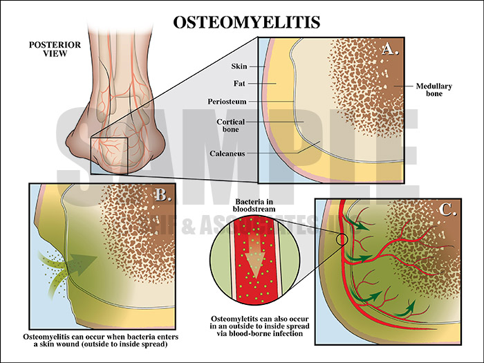 Osteomyelitis Medical Illustration