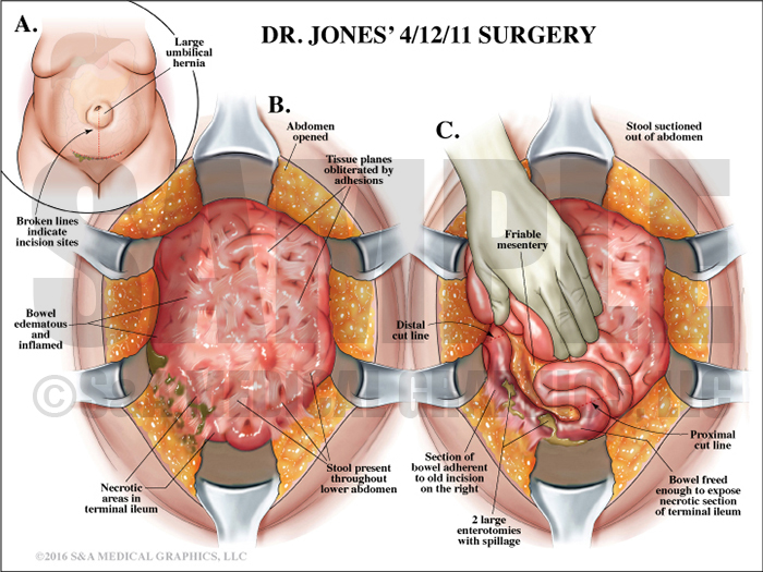 Abdominopelvic surgery bowel perforation