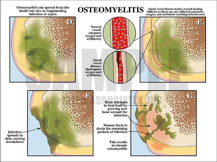 Osteomyelitis Medical Illustration