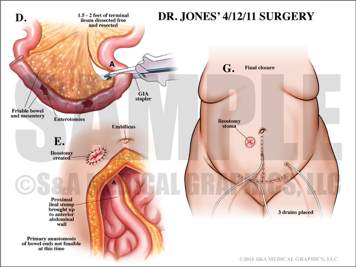 Abdominopelvic surgery