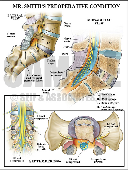 Preoperative Spine Anatomy Medical Illustration