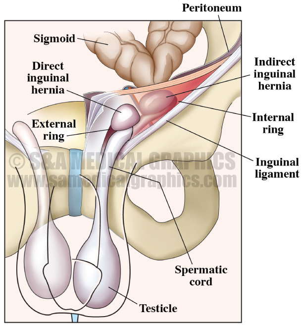 Inguinal Hernia Medical Illustration