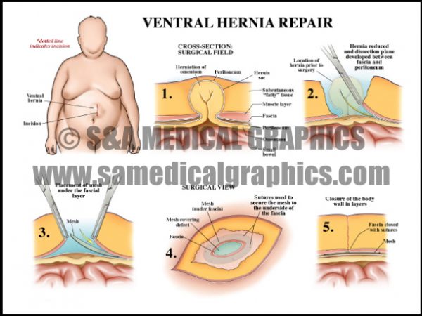 Abdominopelvic Surgery - S&A Medical Graphics