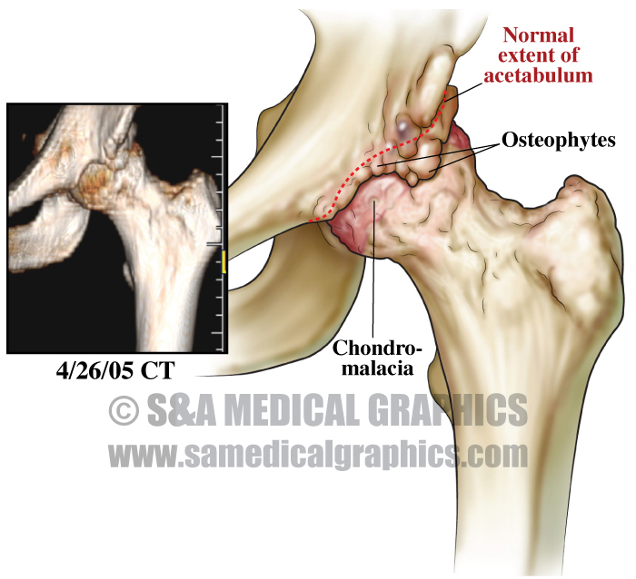 Before Total Hip Replacement Surgery Medical Illustration