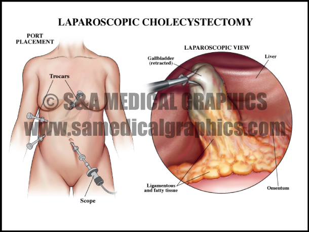 Abdominopelvic Surgery Laparoscopic Cholecystectomy