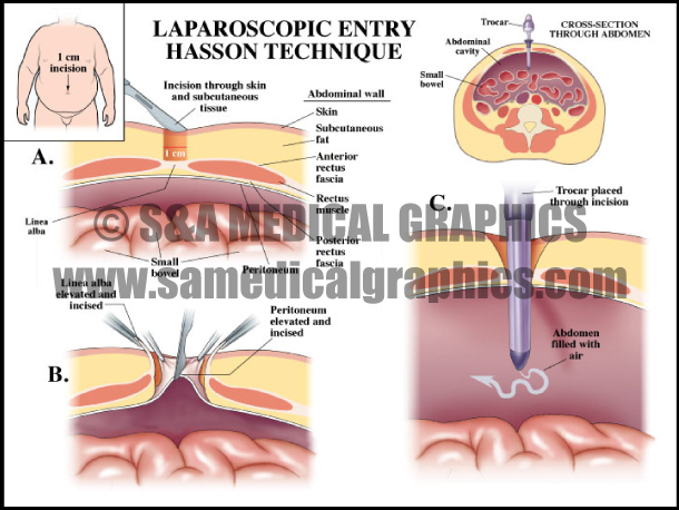 Abdominopelvic Surgery Laparoscopy
