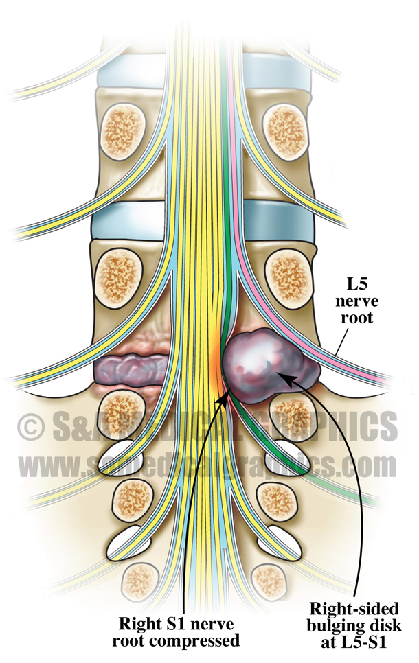 Lumbar Nerve Root Medical Illustration