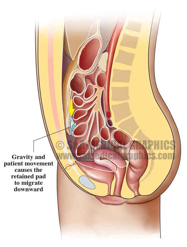 Retained Foreign Body Medical Illustration