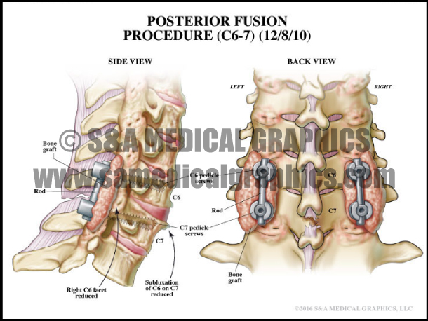 Posterior Spinal Fusion Medical illustration