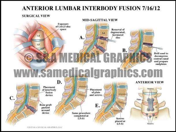 Spine Fusion Surgery Medical Illustration