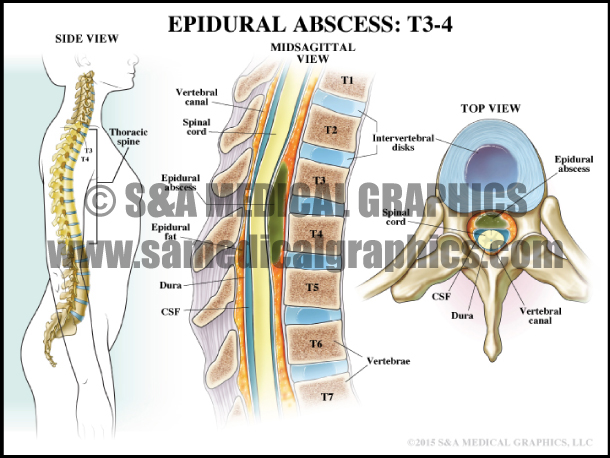 Epidural Abscess Spine Surgery Medical Illustration