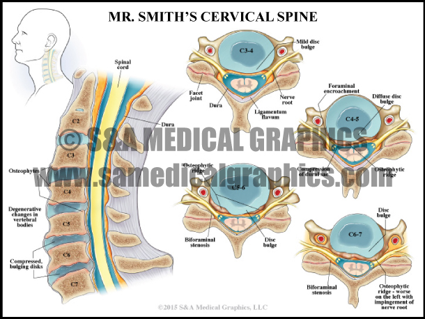 Cervical Spine Bulging Disc Medical Illustration