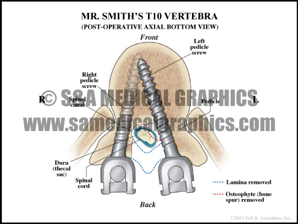 Spine Vertebra Spine Surgery Medical Illustration