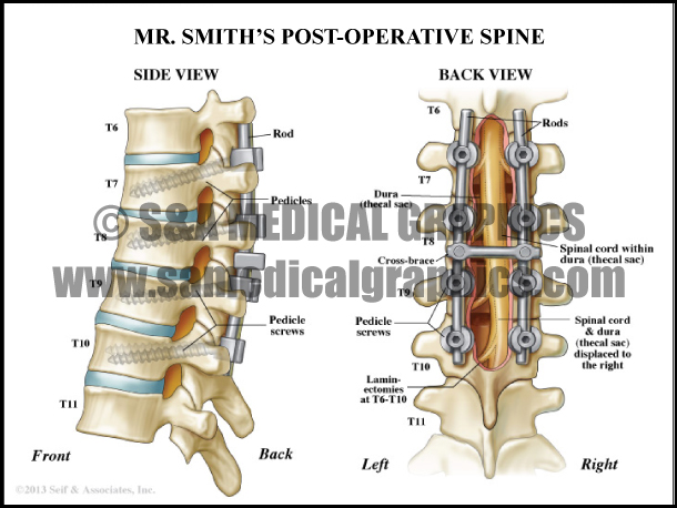 Spine Surgery Medical Illustration