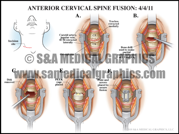 Anterior Cervical Spine Fusion Surgery