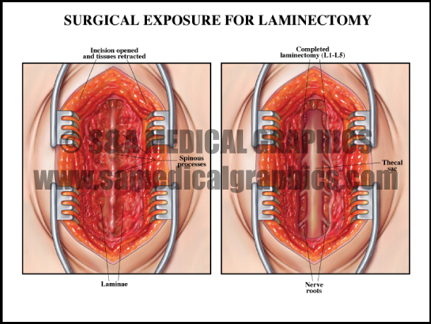 Laminectomy Procedure Spine Surgery