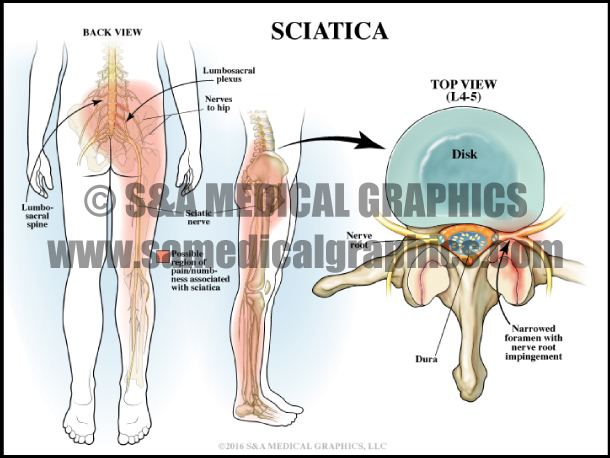 Sciatica Medical Illustration