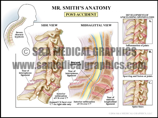 Spine Surgery - S&A Medical Graphics