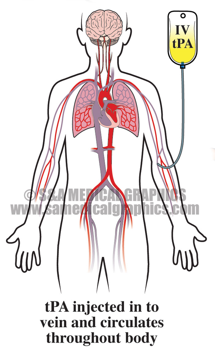 tPA Infusion Medical Illustration