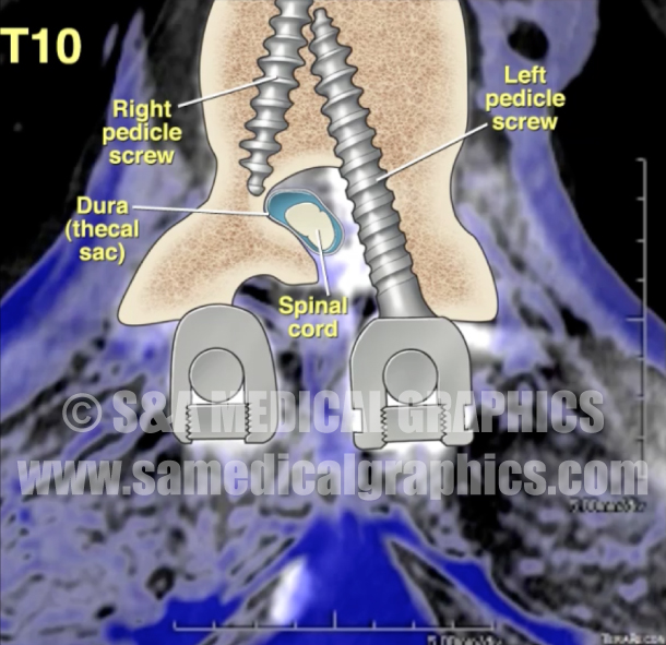 Thoracic Spine Fusion with Medical Illustration