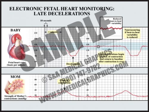 Medical Illustration of Electronic Fetal Monitoring Late Decelerations