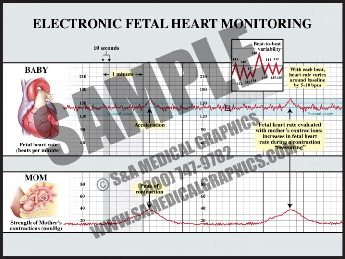 Medical Illustration of Electronic Fetal Monitoring Normal Strip