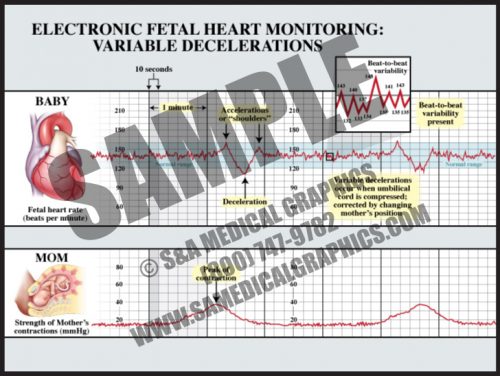 Medical Illustration of Electronic Fetal Monitoring Variable Decelerations