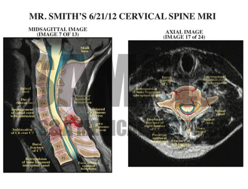 Cervical Spine Injury