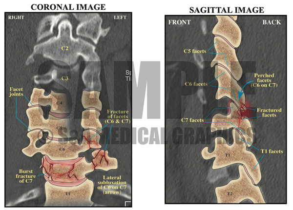 CT Interpretations Bilateral Facet Fractures