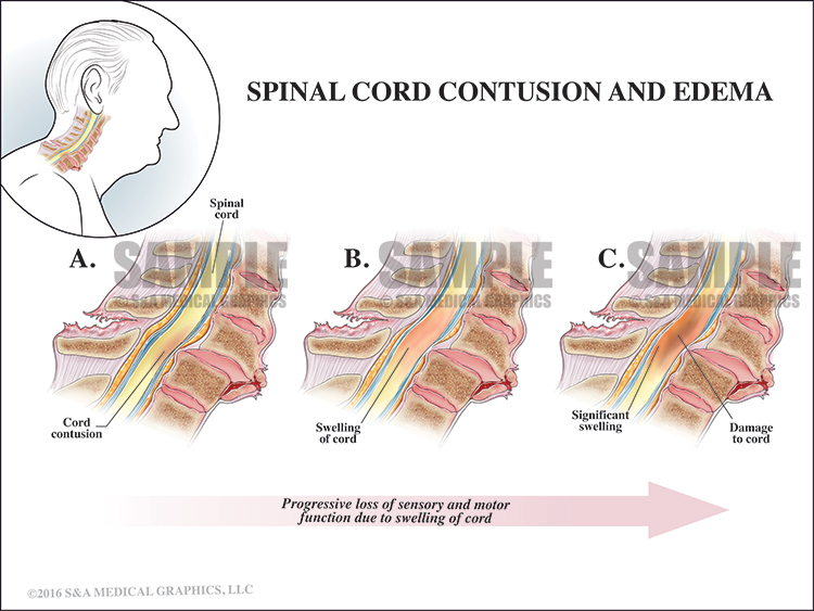 Spinal Cord Contusion and Edema